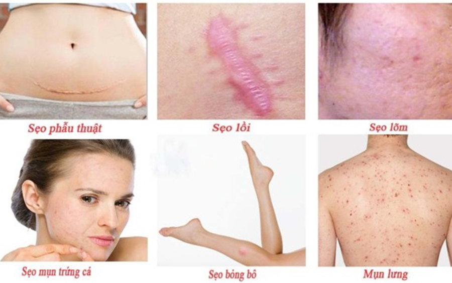 Công dụng kem trị sẹo gentacin nhật bản